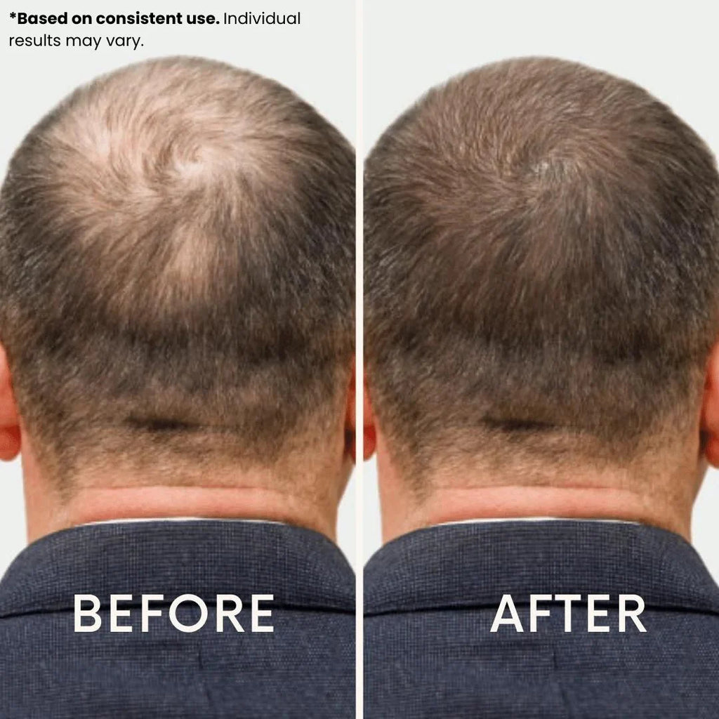 Hysist® Red Light Therapy Hat