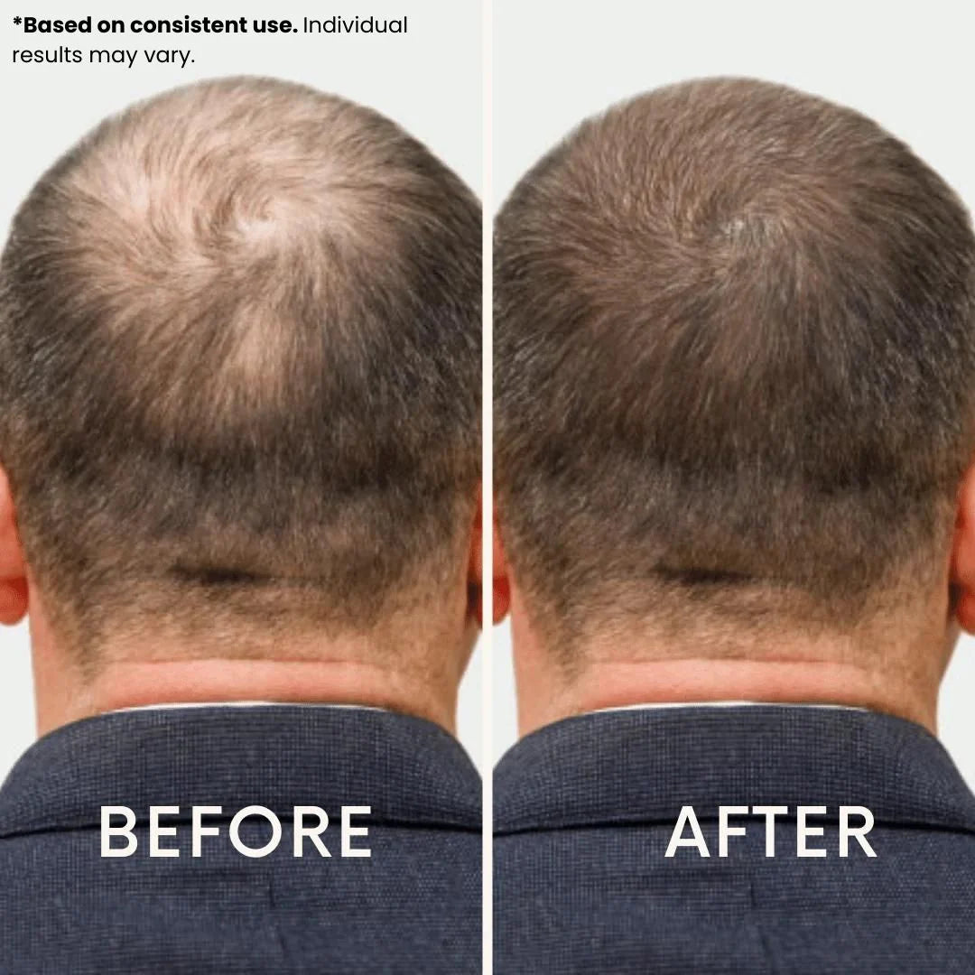 Hysist® Red Light Therapy Hat